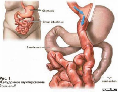 Шунтирование желудка снижает влечение к сладкому