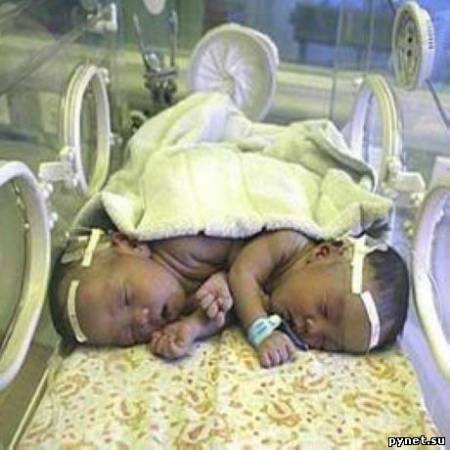 В Китае сиамские близнецы стали просто близнецами